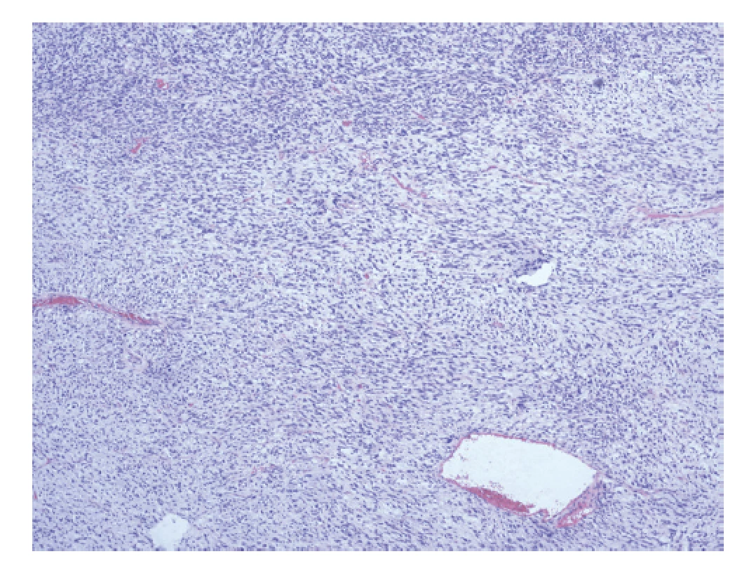 High grade fyloidní nádor, maligní hypocelulární
komponenta s převahou myxoidní matrix.<br>
Fig. 5: High grade phyllodes tumor, malignant hypocellular
component with predominance of myxoid matrix.
