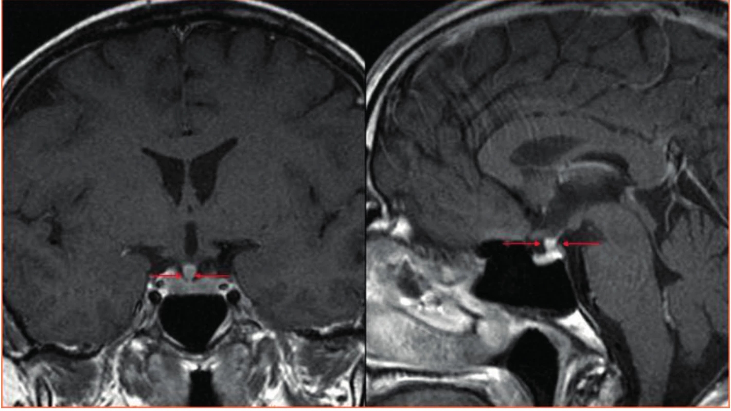 CT zobrazení mozku<br>
Šipky ukazují zesílení stopky hypofýzy u pacienta s Erdheimovou-Chesterovou nemocí, tedy stejné postižení k jakému dochází u pacientů
s histiocytózou z Langerhansových buněk. Tato infiltrace má za následek diabetes insipidus.