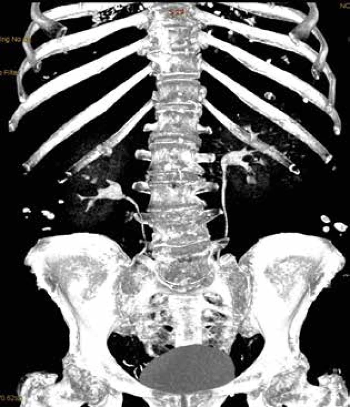 Rekonstrukce CT – vylučovací urografie (chybí náplň kontrastní látkou v horním kalichu pravé ledviny) <br>
Fig. 6: CT reconstruction – excretory urography (absent
contrast agent filling in the upper calyx of the right kidney)