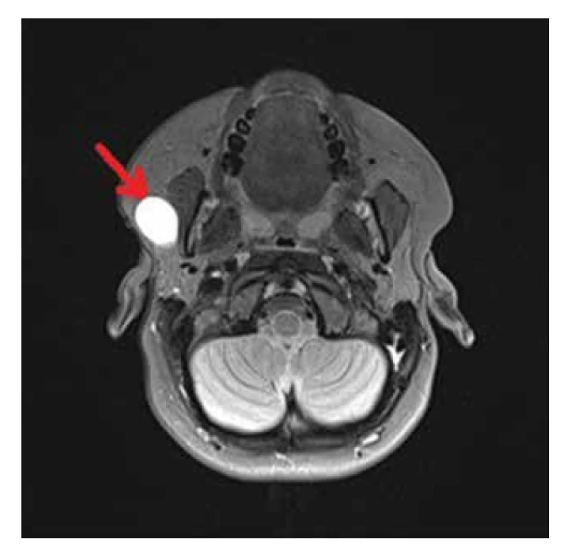 Magnetická rezonance hlavy. Hyperintenzní ložisko
v T2 obraze preaurikulárně vpravo, vel. 33×24×20 mm. Šipka
ukazuje na rezistenci v příušní žláze.