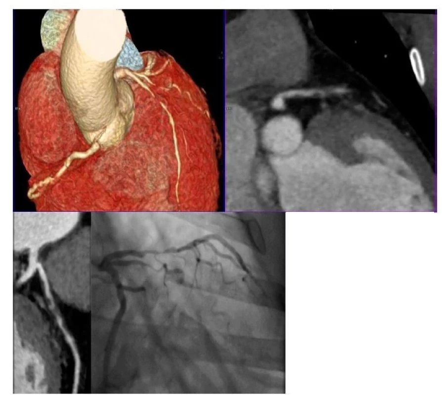 Koronární ateroskleróza s významnými stenózami na CT angiografii koronárního řečiště (A–C) u pacienta s projevy stabilní anginy pectoris v komparaci se selektivní koronarografií (D).