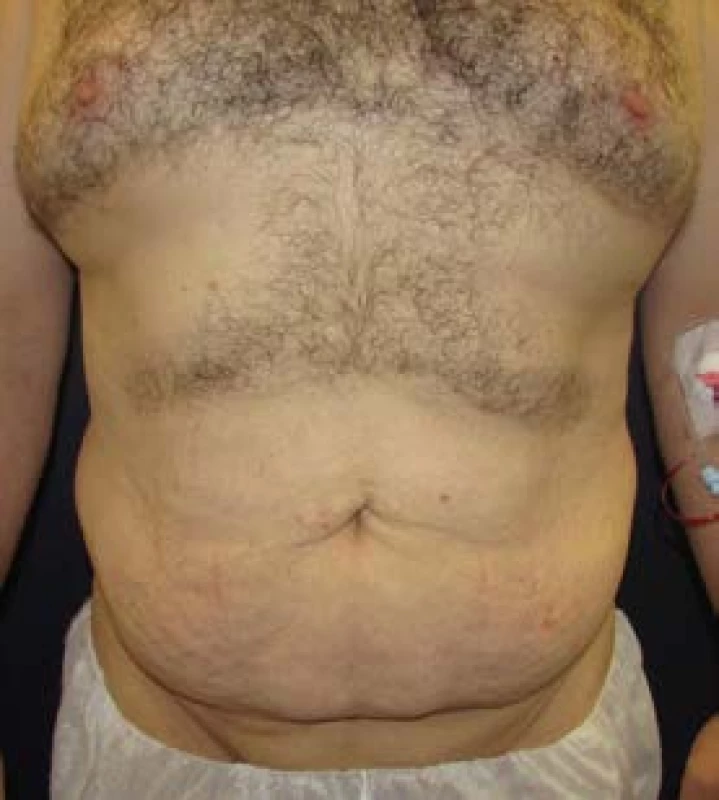 Lower body lifting, 45letý pacient po redukci hmotnosti
o 50 kg pod vedením obezitologa bez bariatrické léčby
– pohled zepředu předoperačně
