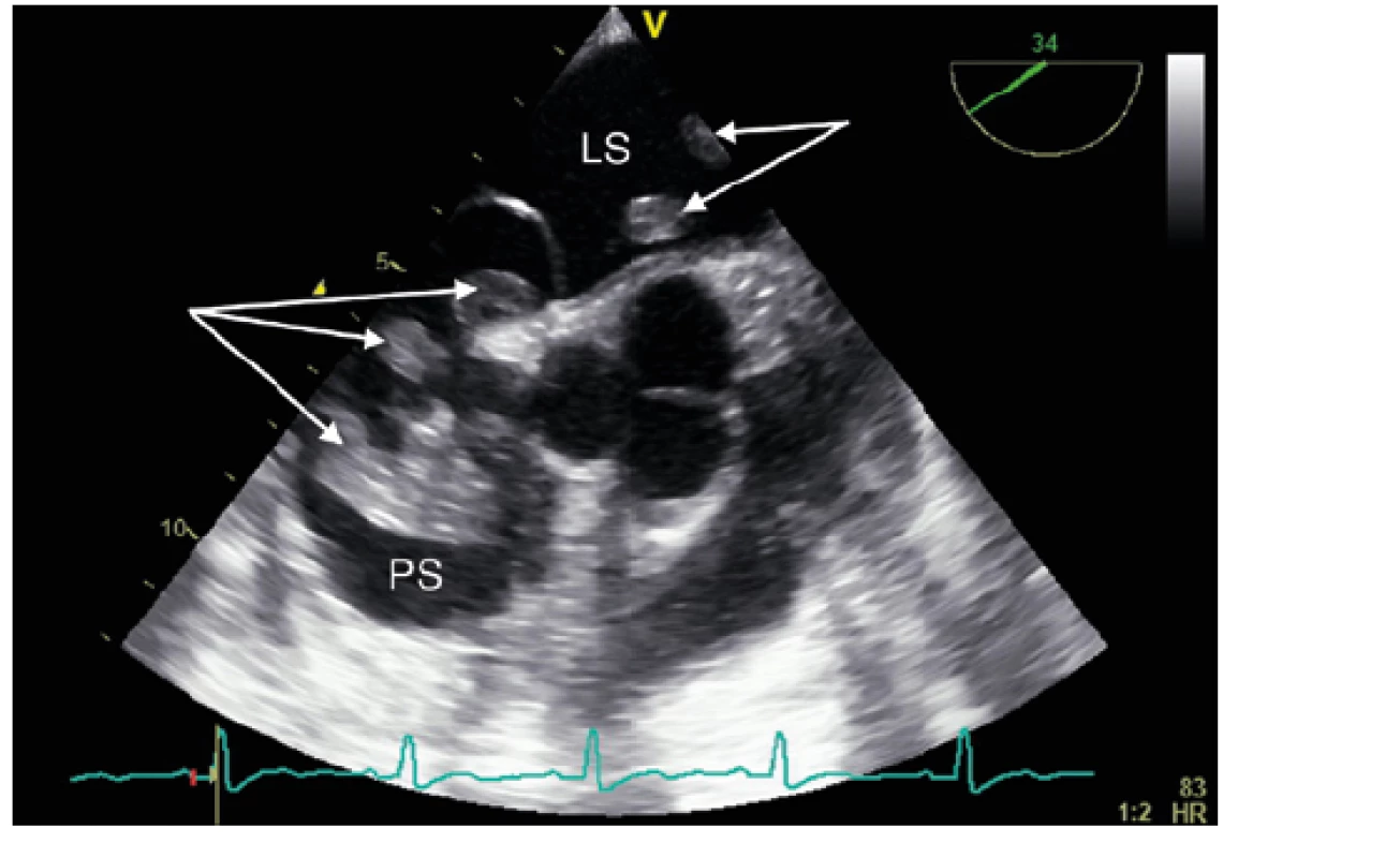 Transezofageální echokardiografie: laločnatý trombus v obou
síních (šipky). LS – levá síň, PS – pravá síň