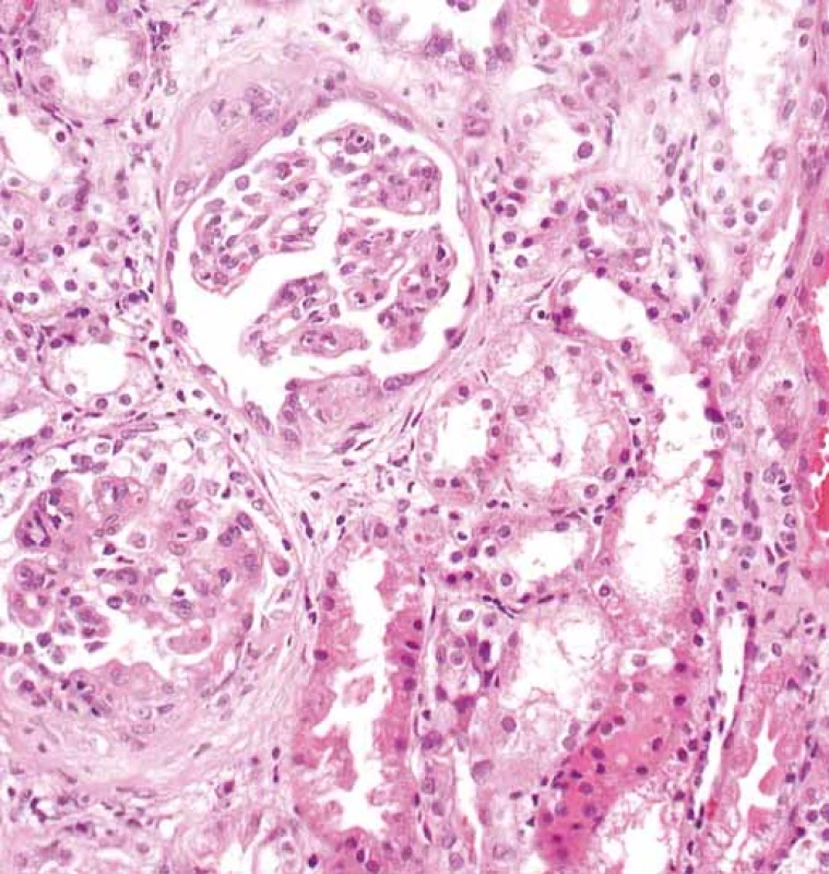 Glomeruly s rozšířenými mezangiálními oblastmi.
V obou glomerulech jsou segmentární projevy sklerotizace
s adhezemi fibroepitelovým srpkům (šipka). Současně
vpravo je erytrocytární válec v lumen tubulu (hematocyklin
a eozin).<br>
Fig. 2. Glomeruli with extended mesangial regions. There
are segmental manifestations of sclerotization with adhesions
to fibroepithelial crescents (arrow) in both glomeruli.
The erythro cyte cylinder is in the tubular lumen (hematocyklin
and eosin) at the same time.