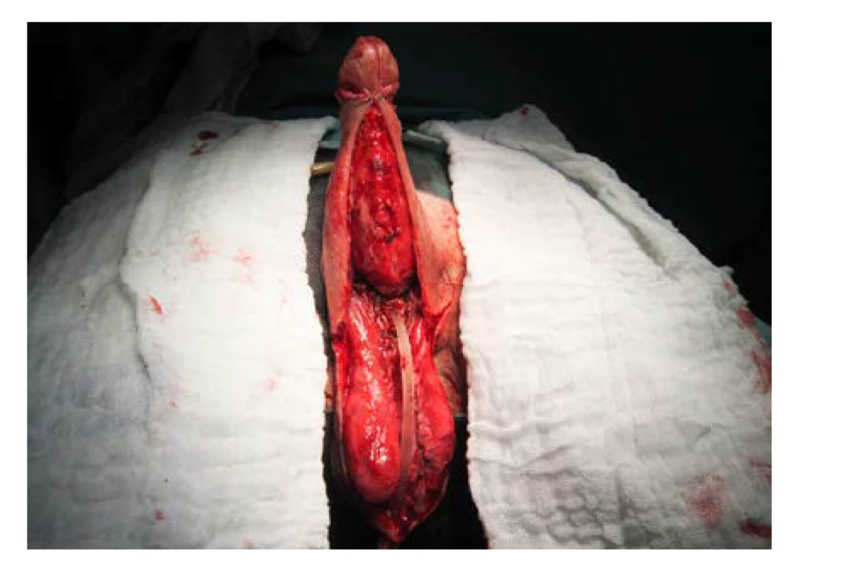 Fixace laloků pod corona glandis, stav před
suturou na ventrální straně penisu<br>
Fig. 8. Flap fixation under the corona of glans penis;
the state prior to suturing at the ventral side of the
penis