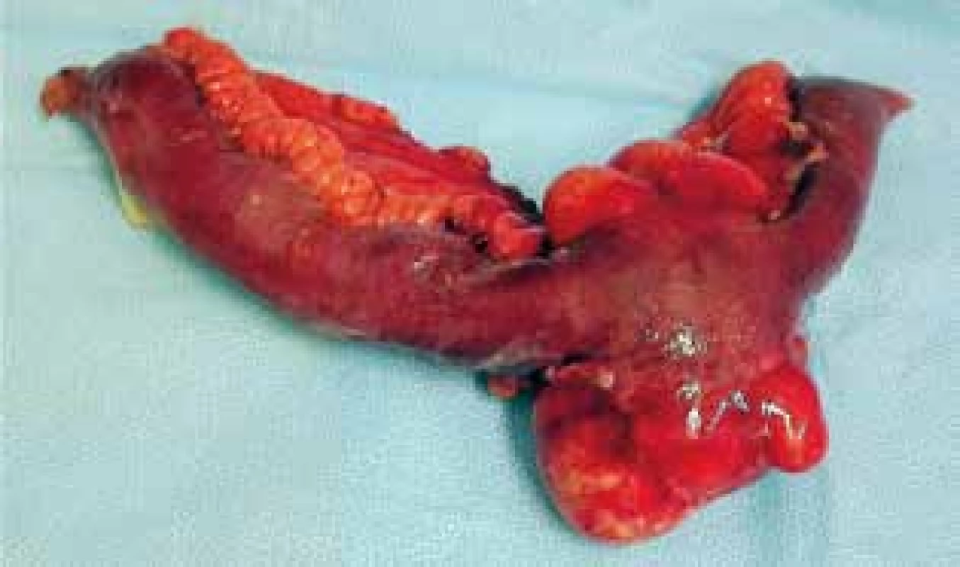 Resekát ilea s abscesem<br>
Fig. 2: Small bowel specimen with the abscess 