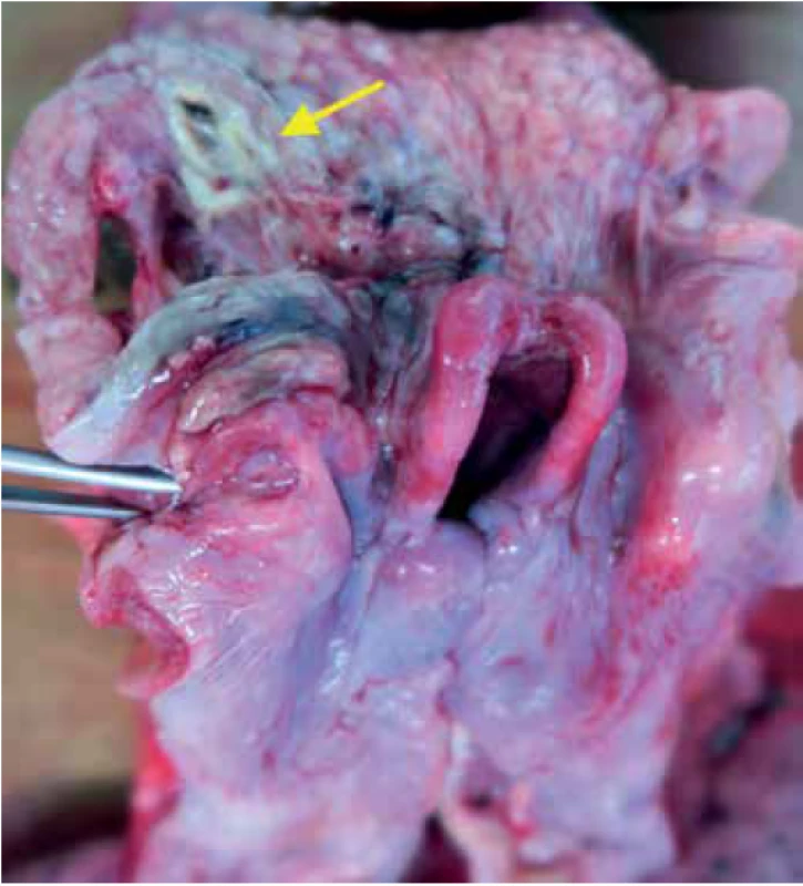 Necrotic focus in the left tonsil (arrow), massive oedema of the epiglottis and adjacent soft tissue.