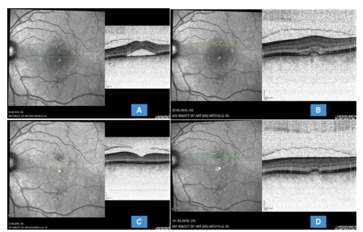Optická koherenční tomografie téže pacientky (HRA-OCT Spectralis Heidelberg): (A) znázorňuje transfoveolární lineární
sken prokazující vysoké serózní odloučení neuroretiny s již dystroficky změněnými fotoreceptory (avšak poměrně dobře zachované
jednotlivé retinální vrstvy). (B) zobrazuje transretinální lineární sken aktivním prosakujícím ložiskem undulujího retinálního pigmentového
epitelu s mírnou exsudativní aktivitou před provedením redukované fotodynamické terapie. (C) snímek 1 rok po provedení
redukované fotodynamické terapie prokazuje kompletní vstřebání subretinální tekutiny, obnovení zóny interdigitací a zřetelného pravidelného
retinálního pigmentového epitelu subfoveolárně a (D) v místě původního aktivního ložiska přetrvává nepravidelný undulující
retinální pigmentový list bez známek aktivity