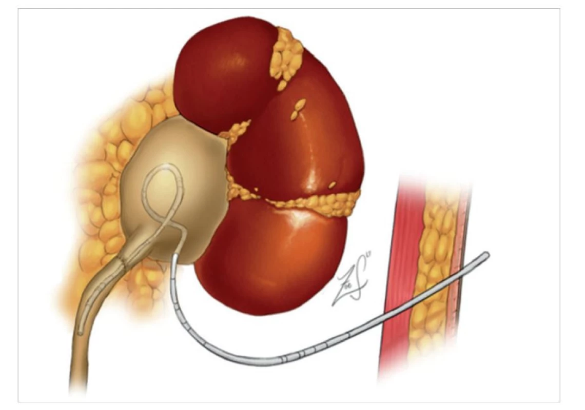Transanastomotická ureteropyelostomie po robotické pyeloplastice<br>
Fig. 1: Transanastomotic uretro-pyelostomy after robotic pyeloplasty