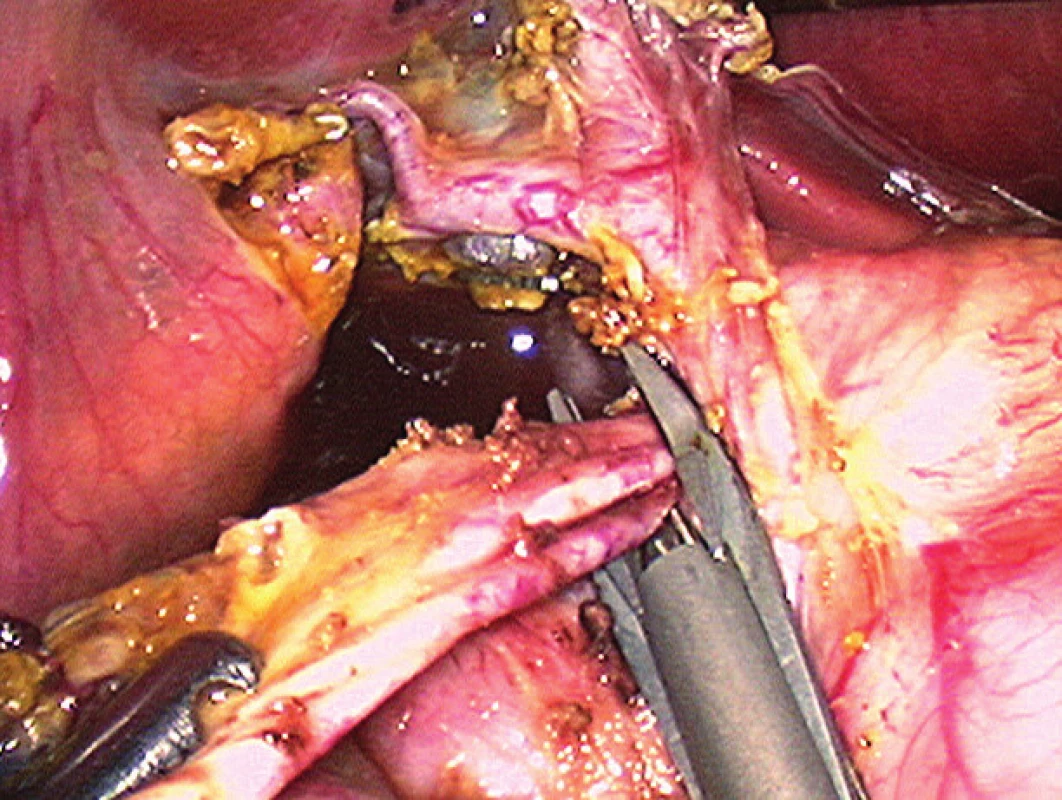 Laparoskopická operácia cystickej malformácie žlčových
ciest.<br>
Fig. 8. Laparoscopic treatment of congental choledochal cyst,