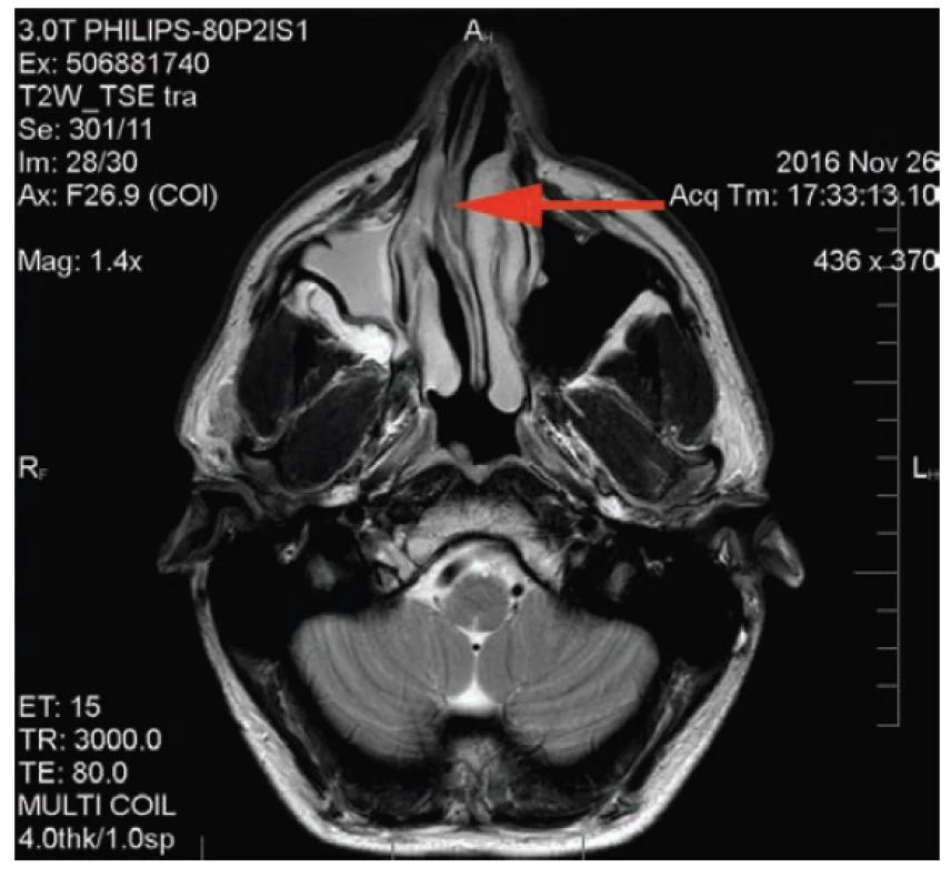 MR scan: nasal septum deviation to the right side