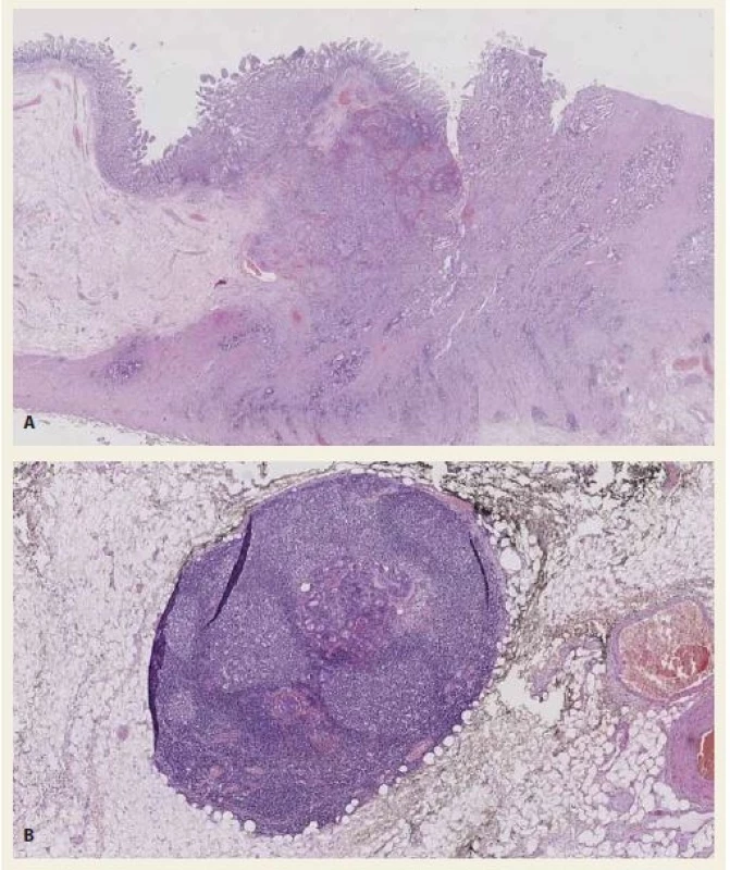 A, B. Histological section – ampullary adenocarcinoma. Tumour glands invade the duodenum wall. Haematoxylin-eosin staining 10× (A). Histological section – regional lymph node with metastasis of the adenocarcinoma. Haematoxylin-eosin staining 40× (B).<br>
Obr. 3. A, B. Histologické vyšetření – ampulární adenokarcinom. Nádorové žlázky invadují stěnu duodena. Barvení hematoxylin-eozinem 10× (A). Histologické vyšetření – regionální lymfatická uzlina s metastázou adenokarcinomu. Barvení hematoxylin-eozinem 40× (B).