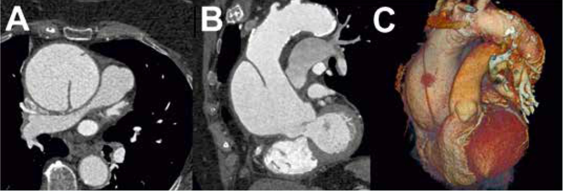 Akutní aortální disekce typu A dle Stanfordské klasifikace při vyšetření CTAG s dobře patrným
intimálním flapem