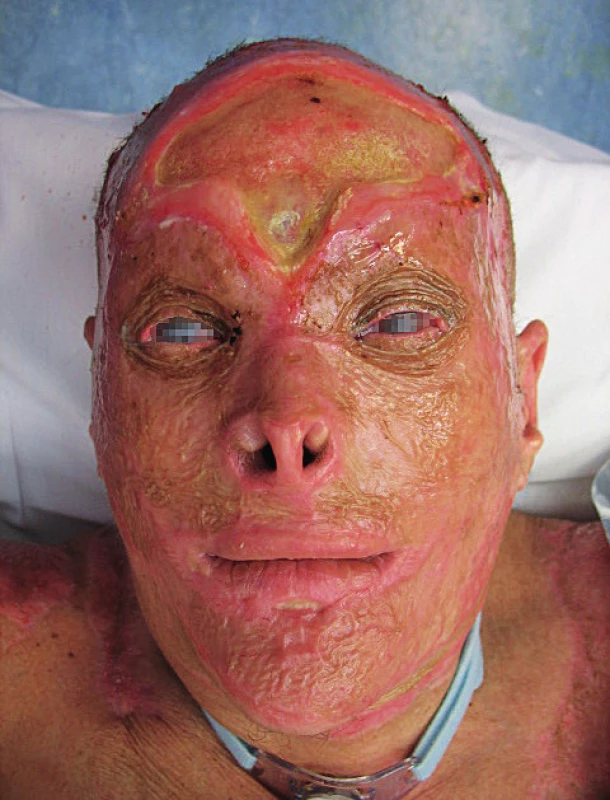 The deep burn defect on the head before reconstruction