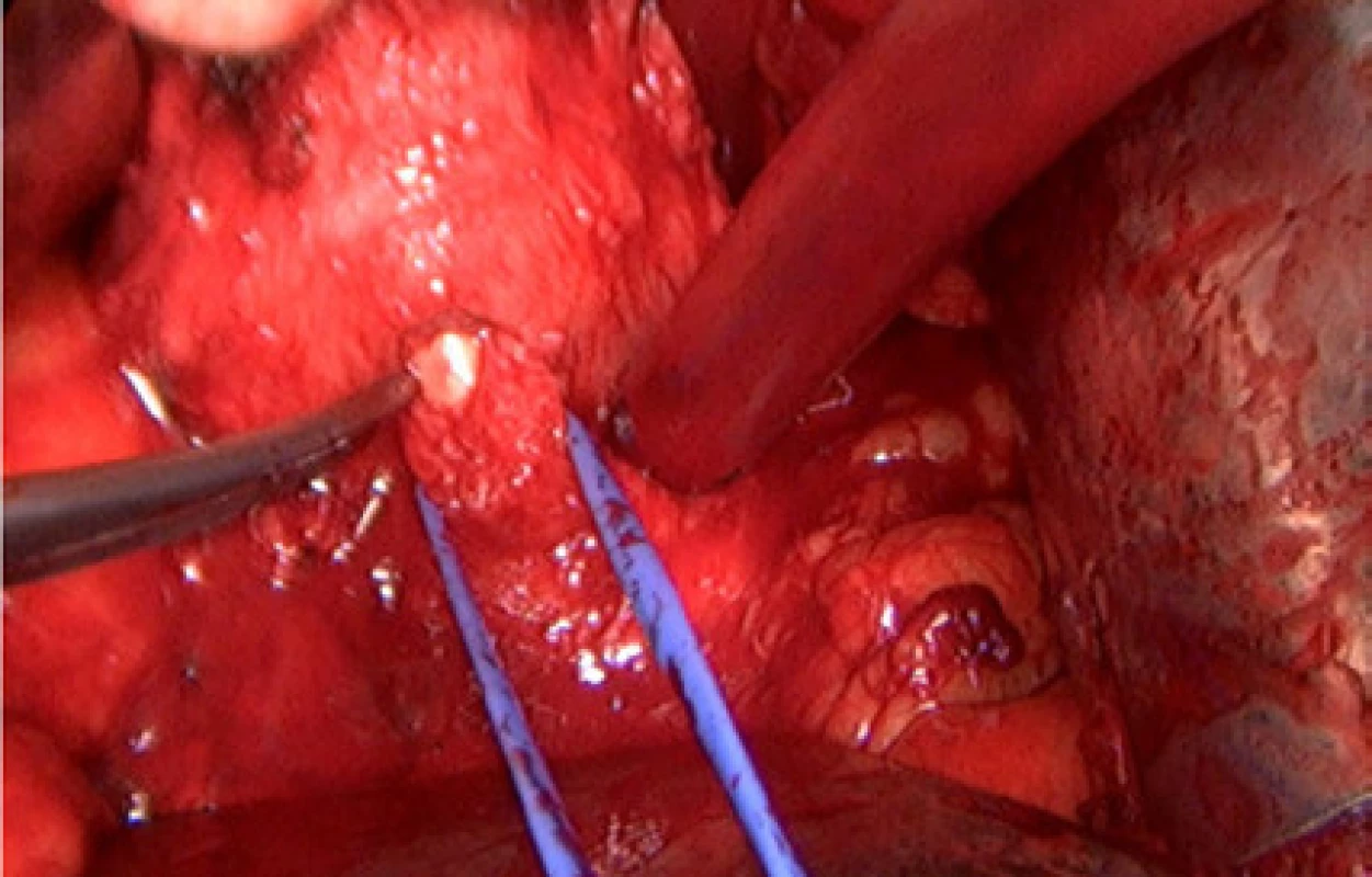 Dokončení přerušení prostatické uretry z dorzální strany<br>
Fig. 6. Completed transection of the prostatic urethra
from the dorsal aspect