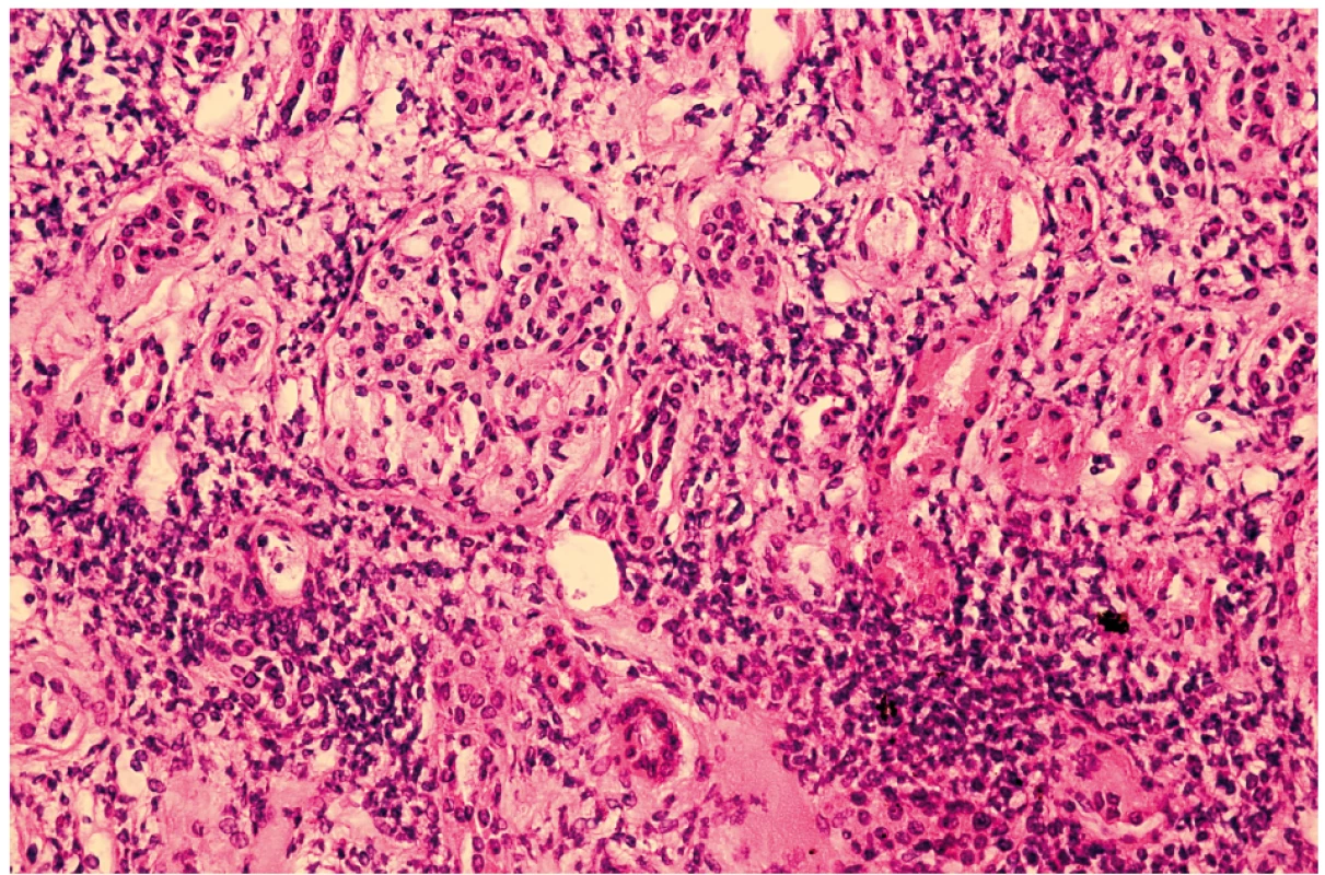 Svetelná mikroskopia obličky u 14-ročného dievčaťa s TINU syndrómom – prítomný lymfoplazmocelulárny infiltrát
s miernou prímesou polymorfonukleárnych leukocytov a minimálnou účasťou eozinofilov.<br>
Fig. 2. Light microscopy of kidney in 14 years old girl with TINU syndrome – shows lymphoplasmacytic infiltration with admixed
polymorphonuclear leukocytes with minimal presence of eosinophils.