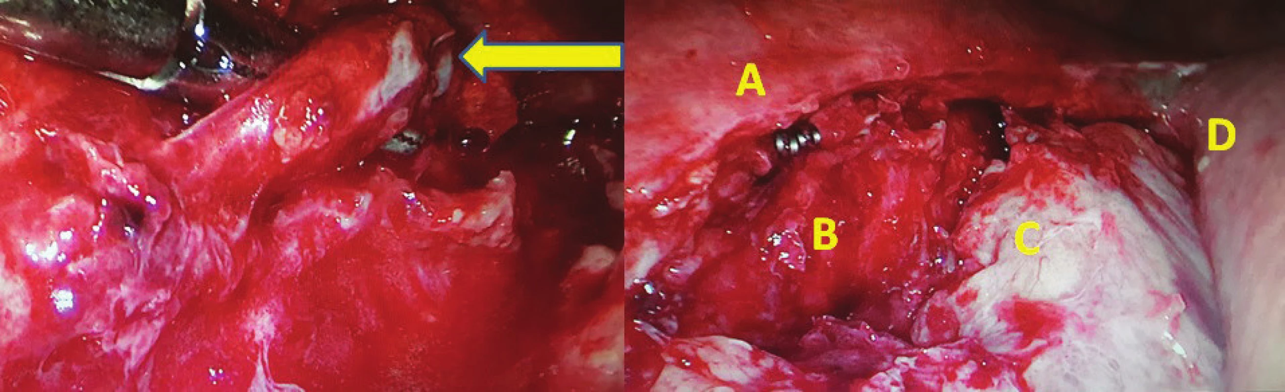 vlevo – torakoskopická revize 8. pooperační den po Ivor-Lewisově ezofagektomii s chylothoraxem (pronační
poloha pacienta), žlutá šipka označuje nástěnné poranění DT; vpravo: A ošetření leze klipem, B descendentní
aorta, C fibrinem krytý plicní hilus, D žaludeční tubus využitý k rekonstrukci<br>
Fig. 2: left – thoracoscopic revision on 8th postoperative day after Ivor-Lewis esophagectomy for chylothorax
(prone position), yellow arrow showing tangential injury of the thoracic duct, right: Double clip on the duplication
of DT, B descending aorta, C pulmonary hilus covered with fibrin, D gastric tube used for GI reconstruction