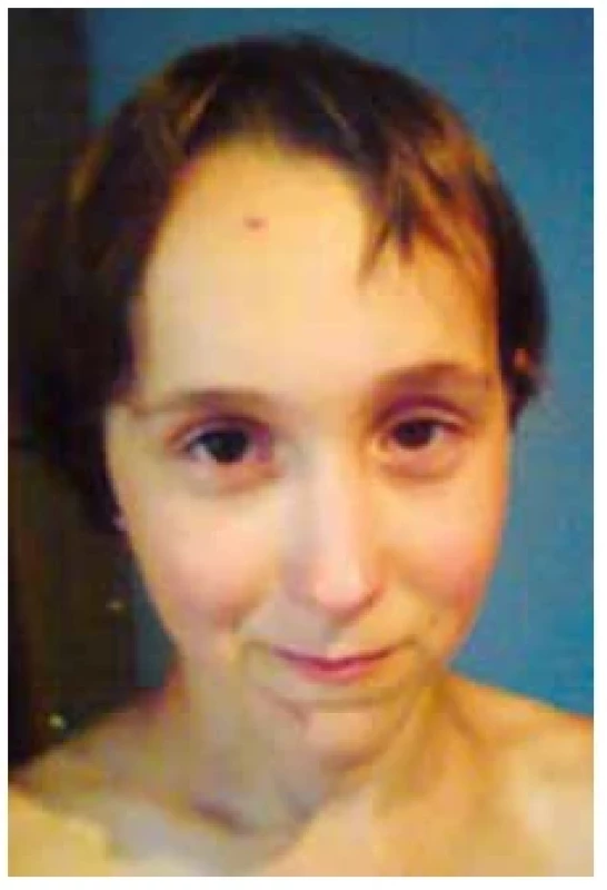 Dívka s typickými
rysy Sotosova syndromu
v obličeji (Rodiče pacientky
poskytli souhlas s publikováním
fotografie)