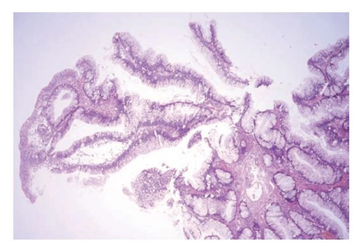 Hypermucinózní (vilózní) dysplázie v terénu idiopatického
střevního zánětu. Hypermucinózní dysplázie je tvořena protáhlými vilózními
nebo větvenými výběžky, které jsou kryté cylindrickým epitelem
s nápadně světlou cytoplazmou a menšími jádry při bazi (hematoxylin
a eosin, 40x).