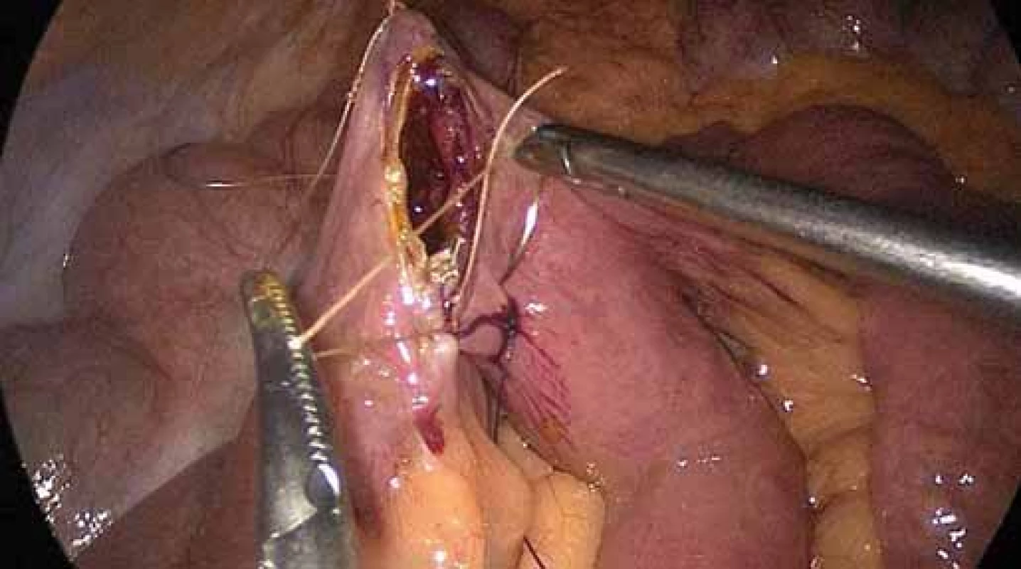 Šití jejun-oileální anastomózy.
Fig. 2. Jejuno-ileal anastomosis suture.