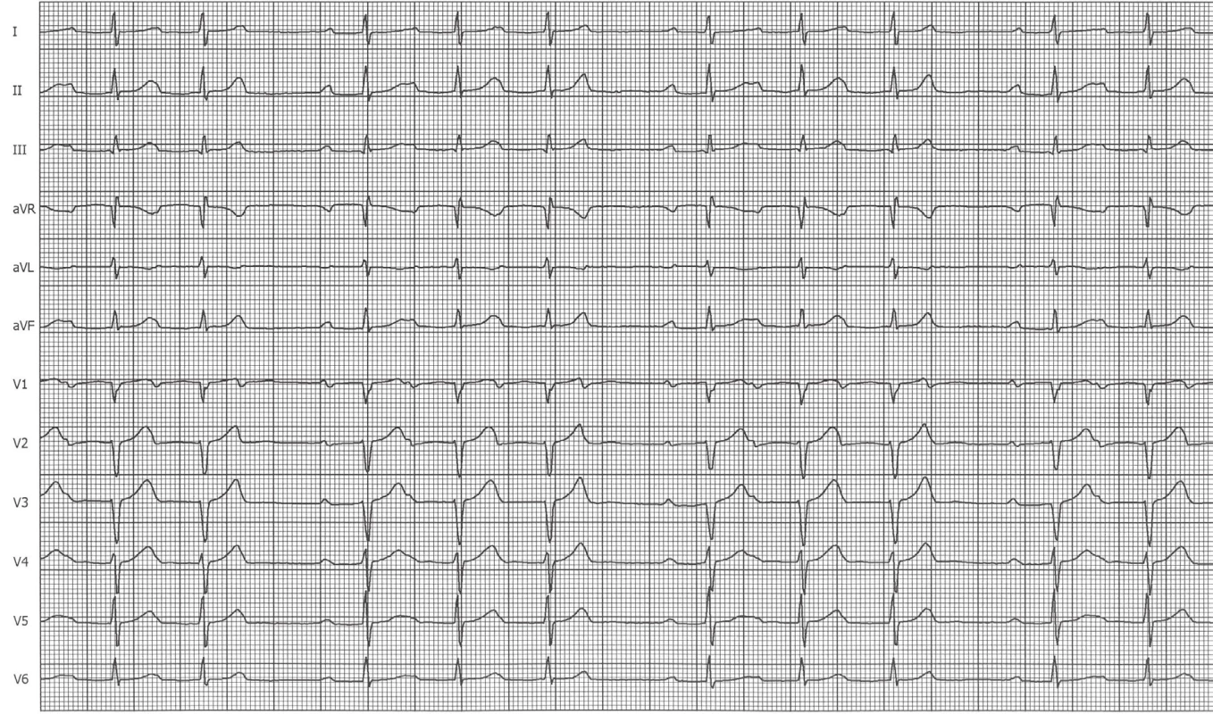 EKG křivka po provedené ablaci