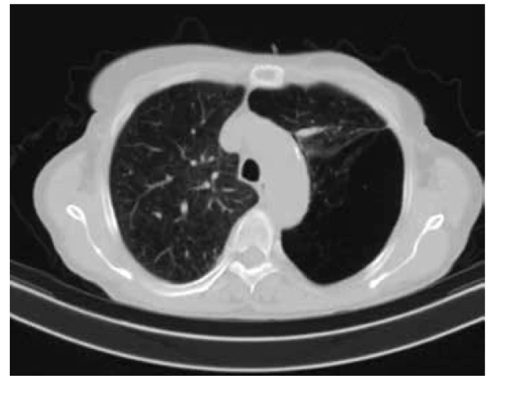 CT hrudníku – řez v úrovni horních laloků ukazuje bilaterální
postižení plicního parenchymu emfyzémem. V levé plíci je patrné vymizení
struktur plicního parenchymu postihující 1/3 plicní plochy