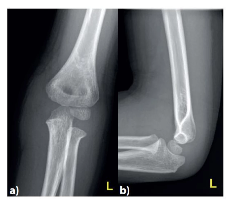 Úrazové snímky<br>
V předozadní a) a bočné b) projekci s patrnou nedislokovanou
separací proximální epifýzy radia a výrazným otokem
v oblasti ulnární strany lokte, imponujícím jako možné poranění
neosifikovaného mediálního epikondylu či celé distální
fýzy humeru.<br>
Fig. 1: Plain X-ray after the injury<br>
Anteroposterior a) and lateral b) views with noticeable nondisplaced
separation of the proximal epiphysis of the radius
and distinctive swelling of the medial part of the elbow joint.