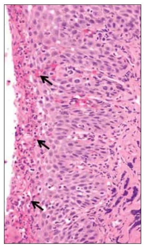 Histologický snímek eozinofilní ezofagitidy
– nediferencované T-buňky, ve sliznici jícnu.
