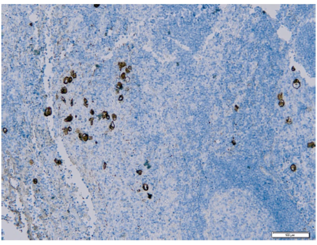 Izolované nádorové buňky v sentinelové lymfatické uzlině
s pozitivním průkazem při imunohistochemickém vyšetření (Ústav
klinické a molekulární patologie LF UP a FN Olomouc)