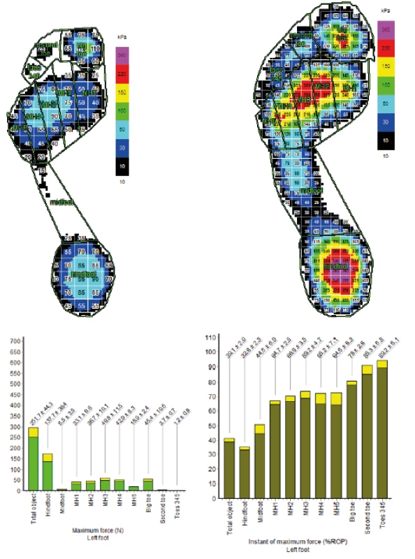 Loading of the patient‘s limb after the third week - load distribution
on the plantar side of the foot and a graphical representation of
the load distribution. The patient starts with one third of the load by
his own weight. In this particular case, it is 27 kg