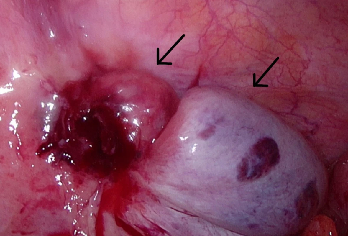 Operační nález: vlevo retinované varle, vpravo
apendix<br>
Fig. 1: On-site situation: Ascended testicle (left); appendix (right)