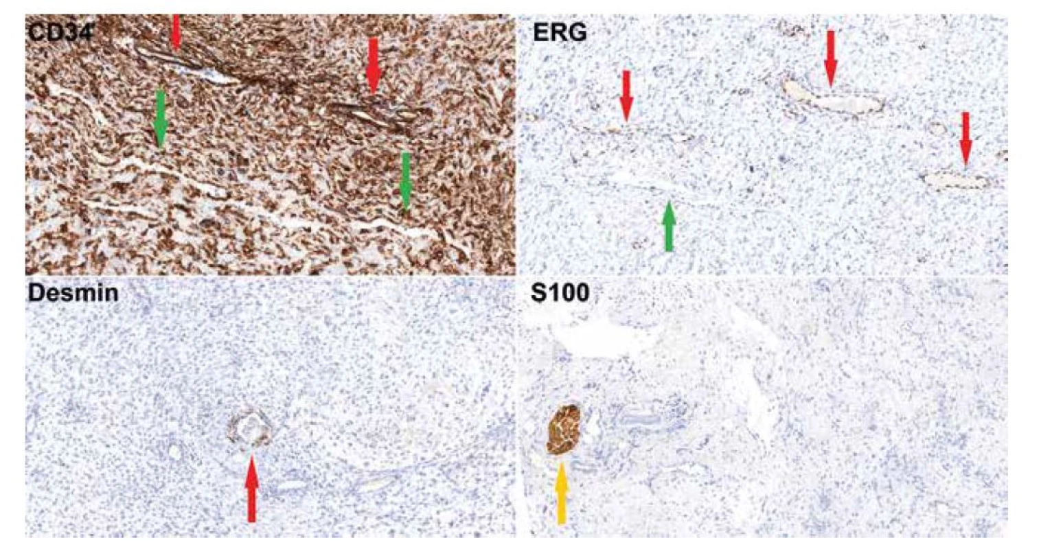 Imunohistochemické vyšetření (20x) dokumentující silnou cytoplazmatickou pozitivitu CD34 ve vřetenitých buňkách, obrovských buňkách, ve
výstelce pseudovaskulárních prostor (zelená šipka) i v pravém endotelu (červená šipka). ERG je pozitivní jen ve výstelce pravých kapilár (červená šipka),
zatímco buňky pseudovaskulárních prostor jsou negativní (zelená šipka). Desmin je pozitivní v hladkosvalových buňkách kolem pravých cév (červená
šipka), samotný nádor je negativní. S100 protein reaguje s periferními nervy v peritumorózních měkkých tkáních (žlutá šipka), nádor je negativní.