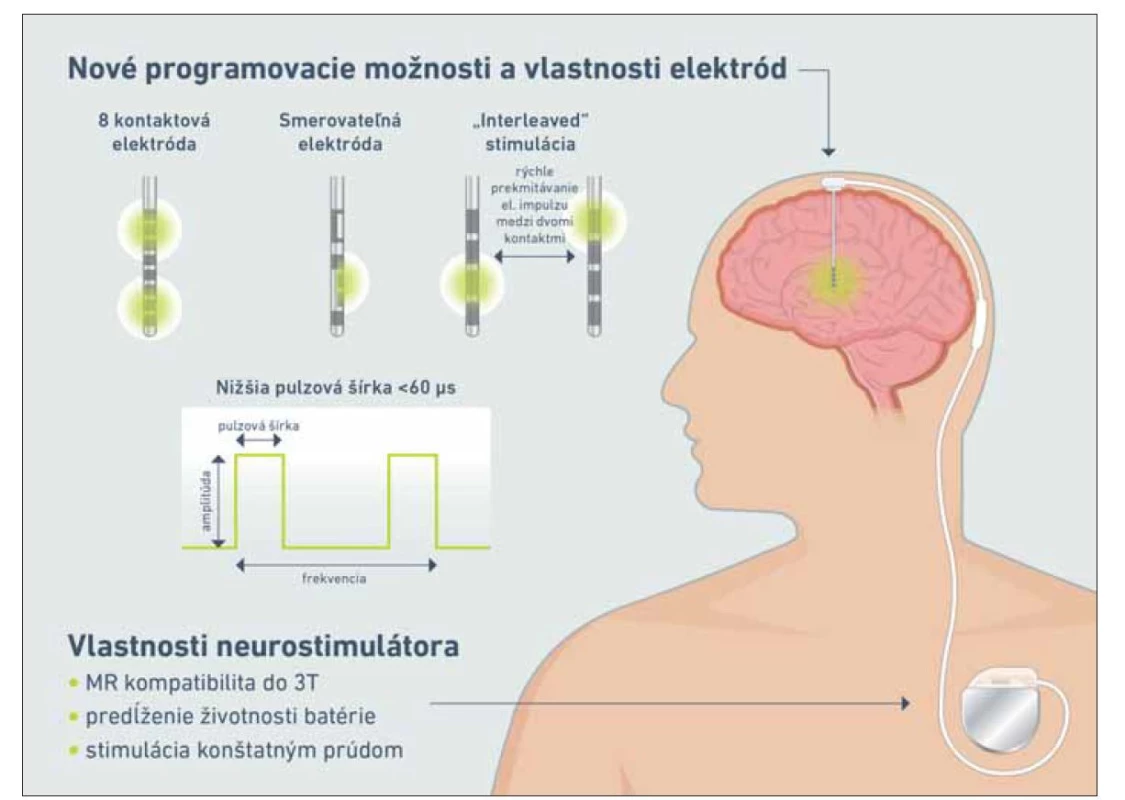Hardvérové technologické inovácie hlbokej mozgovej stimulácie.<br>
Fig. 2. Hardware technological innovations of deep brain stimulation.