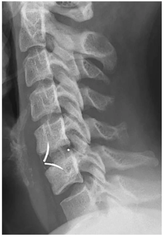 X-ray image after implantation of ROI-C cage in
level C5-6
