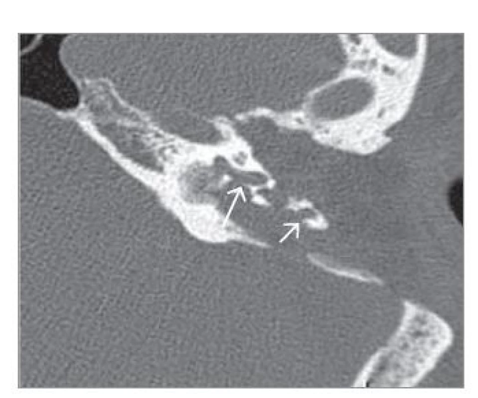 HRCT spánkových kostí –
pred 5. revíznou operáciou. Deštrukcia
kochley (dlhá šípka) a mastoidálneho
úseku kanála tvárového nervu
(krátka šípka).<br>
Fig. 1. HRCT of the temporal bones –
before the 5th revision operation.
Destruction of the cochlea (long arrow)
and mastoid section of the facial nerve
canal (short arrow).