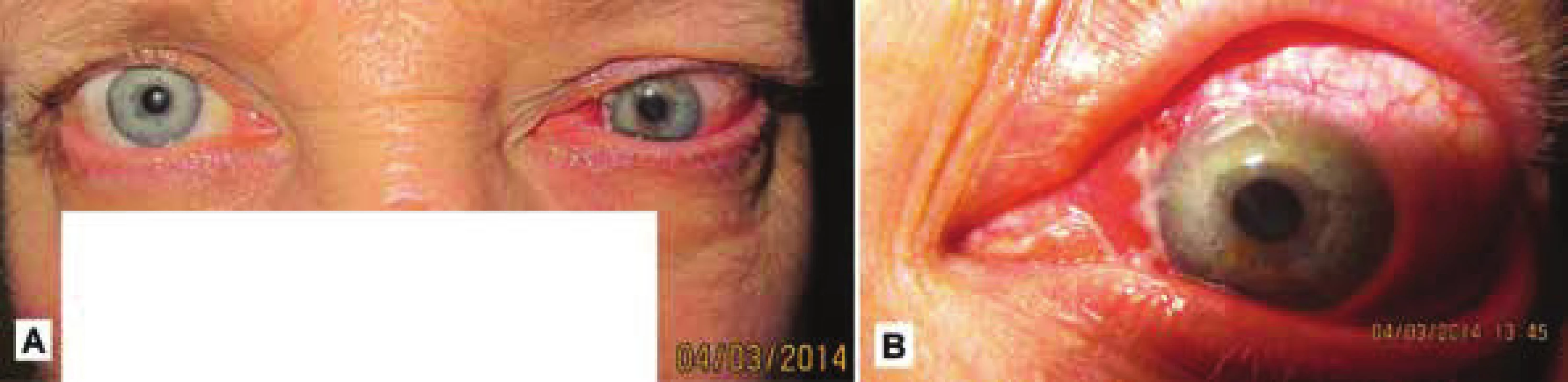Klinický
obraz u toho
istého pacienta
v marci 2014 –
progresia s tendenciou
infiltrácie
do očnice