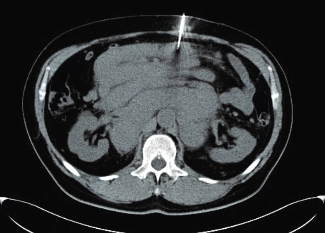 Axiální řez CT z jehlové biopsie nitrobřišní lymfadenopatie pod CT kontrolou