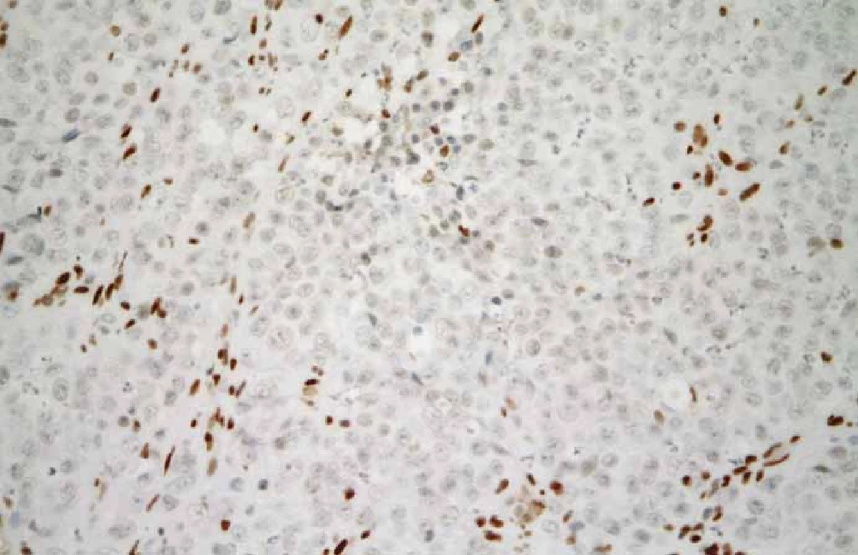 Malobuněčný karcinom hyperkalcemického typu. Nádorové buňky jsou negativní
při průkazu SMARCA4. Hnědé zbarvení jader nenádorových fibroblastů a zánětlivých
buněk lze využít jako pozitivní vnitřní kontrolu (imunohistochemie, původní
zvětšení 400×).