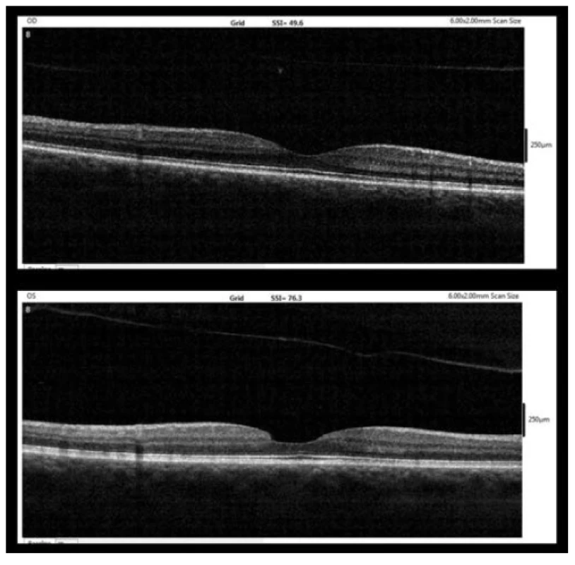 OCT nález 6 měsíců po diagnóze MD (3/2018, nahoře –
pravé oko, dole – levé oko)