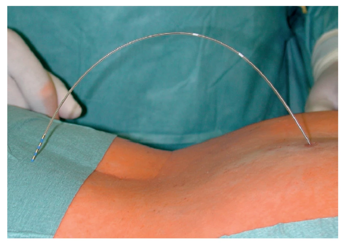 Zavedená „tined lead„ elektroda<br>
Fig. 2: Implanted “tined lead“ electrode
