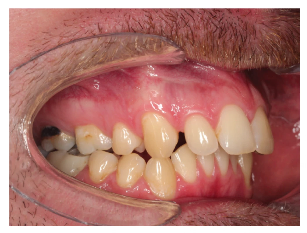 a Lateral cross bite in patient with extracted upper first premolars and increased overjet