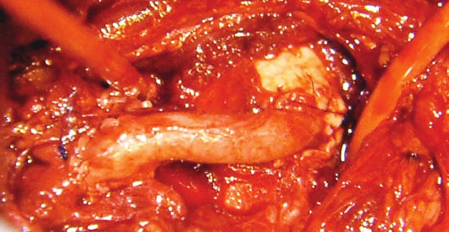 Aorto-trunkálny venózny bypass<br>
Fig. 3: Aorto-celiac venous bypass