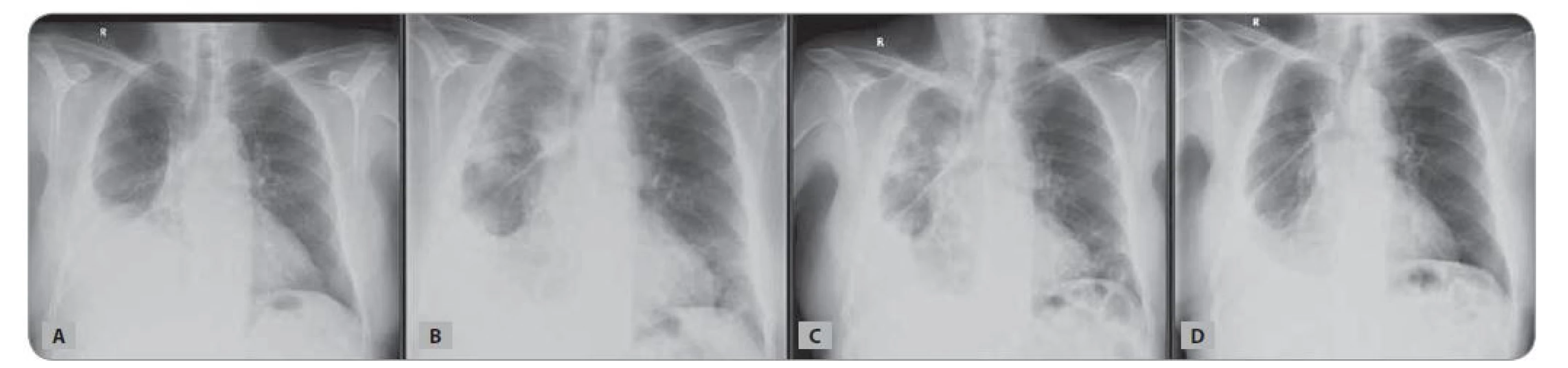 Skiagram hrudníku nemocného z Kazuistiky 1: A) v době zahájení chemoterapie; B) v době pneumonie COVID-19; C) při hodnocení
efektu léčby; D) v odstupu 3 měsíců od koronavirové infekce.