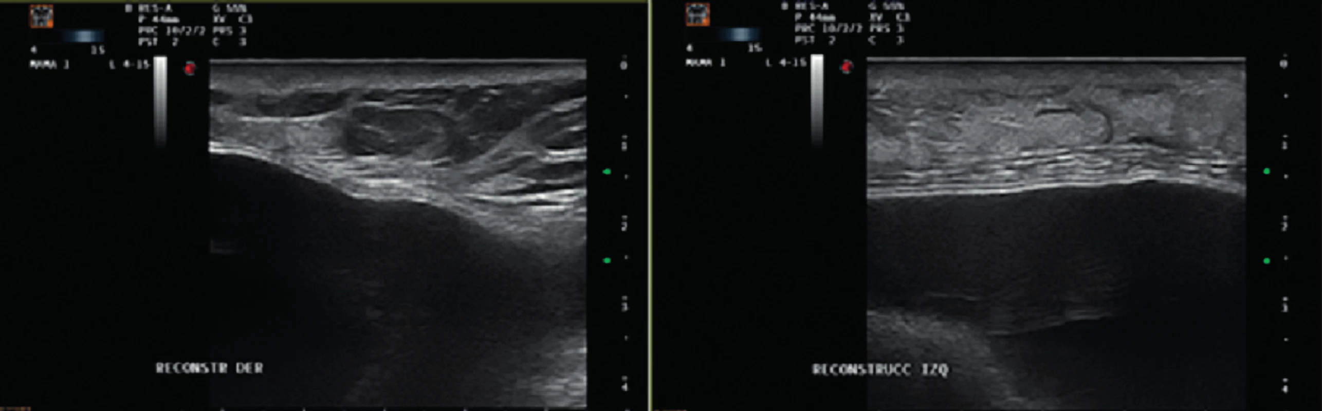 Ultrasound images showing no evidence of seroma or abscess on the right and left sides
Figure