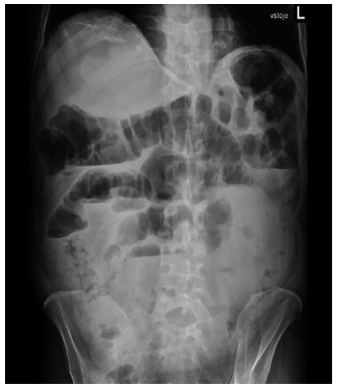RTG břicha – v den přijetí<br>
Fig. 1: Abdominal X-ray – on the day of admission