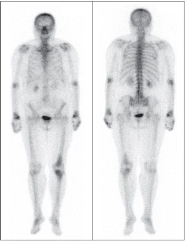 WB scany s patologickým ložiskovým zvýšením
akumulace radiofarmaka v okolí levého kolenního kloubu, projekce přední (vlevo) a zadní. 