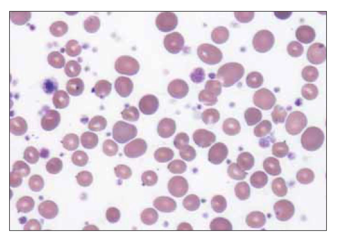 Erytrocyty a četná populace makrotrombocytů
v nátěru periferní krve u esenciální trombocytemie<br>
(zdroj: laboratoř IV. IHK).