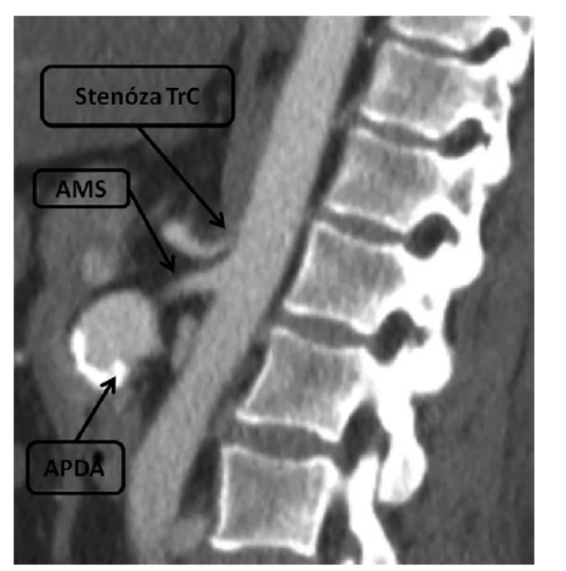 CT obraz, aneuryzma pankreatikoduodenální arkády
a stenóza odstupu truncus coeliacus<br>
Fig. 1: CT scan, pancreaticoduodenal arcade aneurysm
and stenosis of coeliac trunk origin