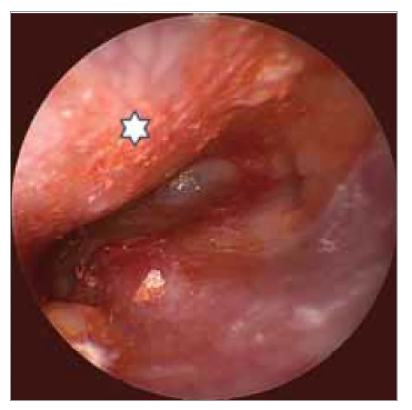 Otoendoskopický pohled na
dekonturovaný levý bubínek vyklenutý
na základě tumorózní masy
ve středouší. Hvězdičkou je označen
převis přední stěny zvukovodu,
podmíněný temporomandibulárním
kloubem.<br>
Fig. 1. Otoendoscopic view of a defigured
bulging left ear drum on the basis
of a tumorous mass in the middle ear.
An asterisk indicates the overhang of
the anterior wall of the auditory canal,
above the TM joint.