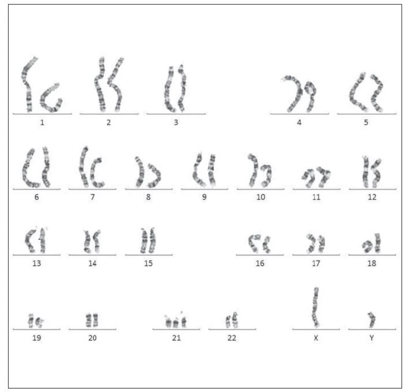 Karyotyp pacienta č. 1 – volná trizomie chromozomu 21.
